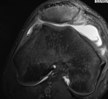 Patella DIslocation MRI OCD LFC MPFL Patella Chondral Damage